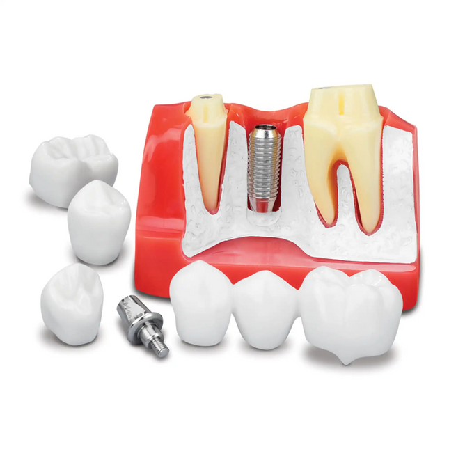 Practicon - Implant Analysis Model To Explain Treatment Options. Demonstrate Dental Bridges