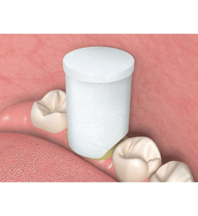 Traxodent Retraction Caps, # 1, Small, 120/Pk, 9048251