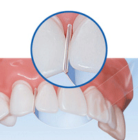 Stop Strip Matrix Bands, 8 mm, 100/Box, 9061375